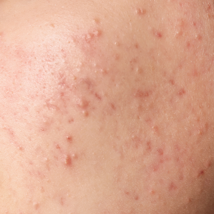 Acne Repair